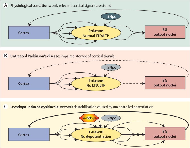 Levodopa-Induced Dyskinesia in Parkinson Disease